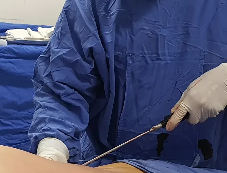 liposucción liposuccion