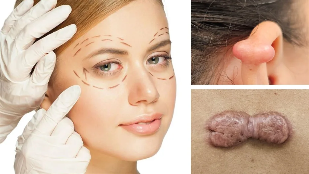 Cicatriz queloide e hidertrófica