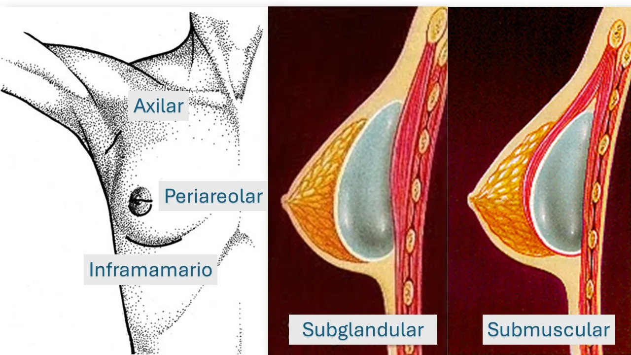 incisión y plano aumento mamario incision-y-plano-aumento-mamario
