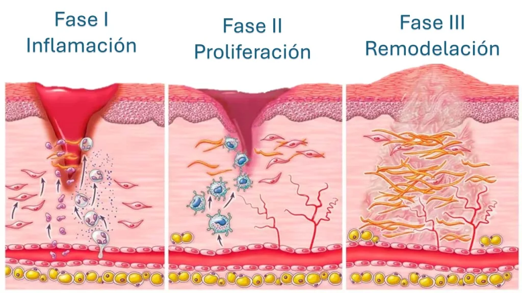Cuidados básicos para prevenir cicatrices queloides e hipertróficas 1 proceso-de-cicatrización
