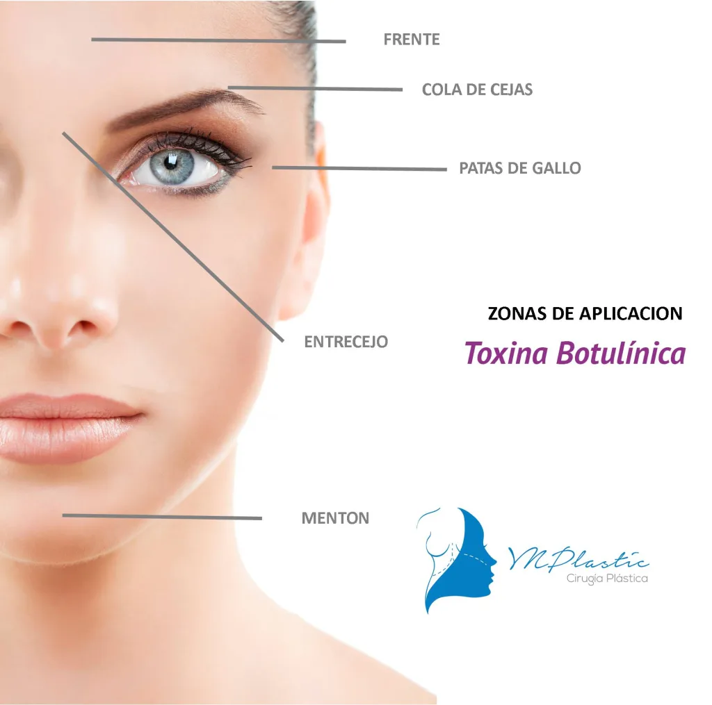 Toxina Botulínica tipo A 1 Sitio-de-aplicacion-de-tocina-botulinica