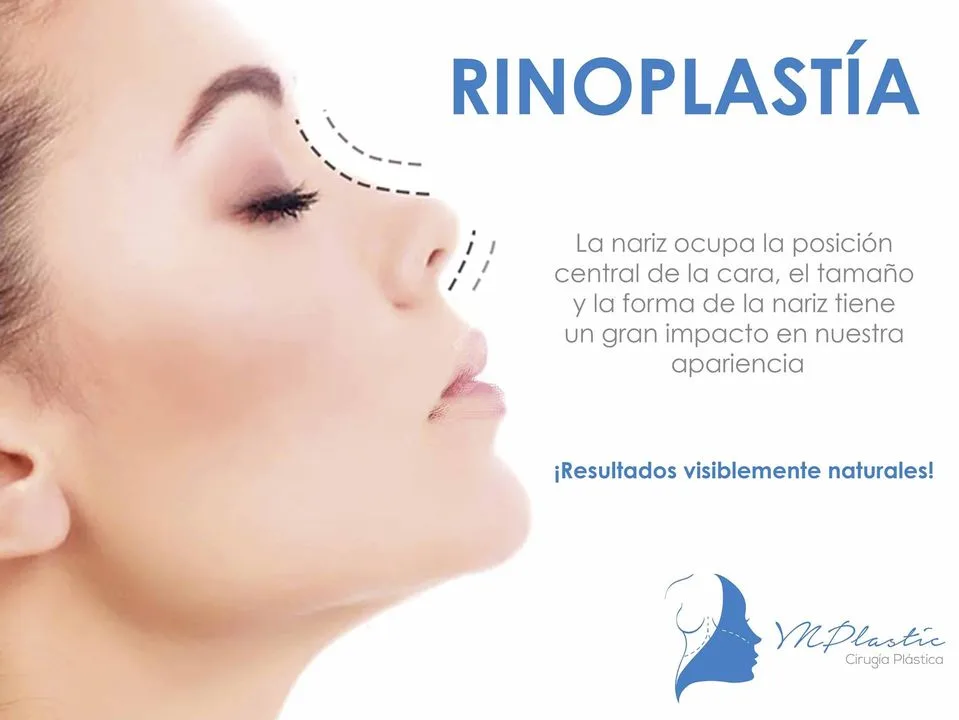 rinoplastia