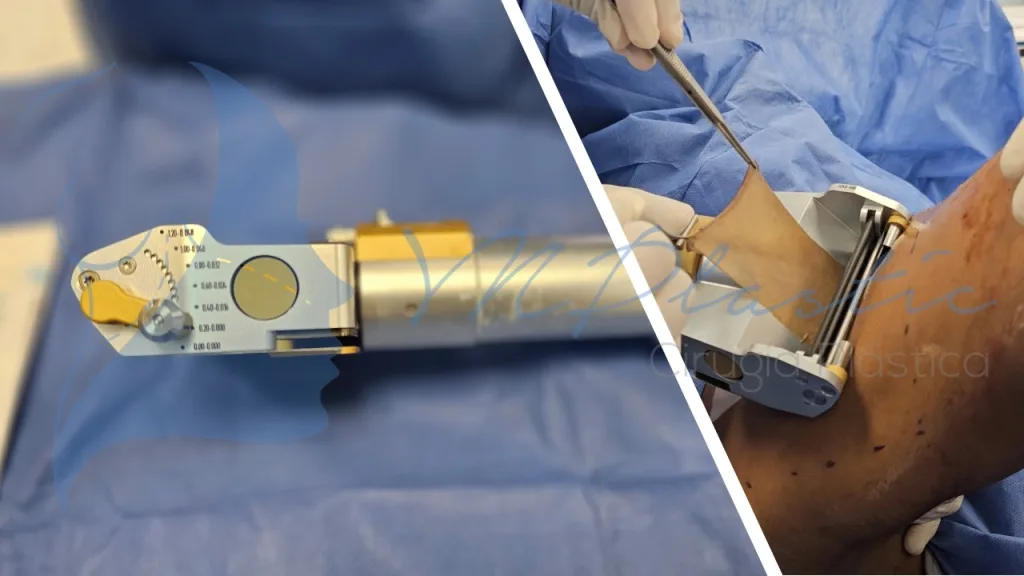 Microinjertos Meek: Innovación en el Tratamiento de Grandes Quemaduras y Pérdida de Tejido 2 Toma de injerto con dermatomo