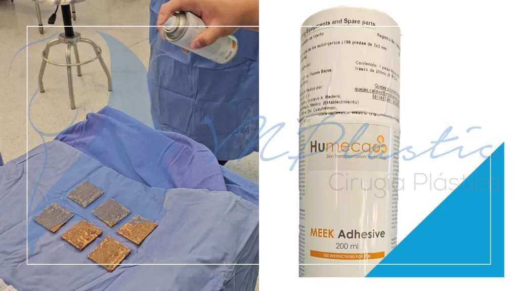 Microinjertos Meek: Innovación en el Tratamiento de Grandes Quemaduras y Pérdida de Tejido 4 aplicacion_adhesivo_microinjertos_meek