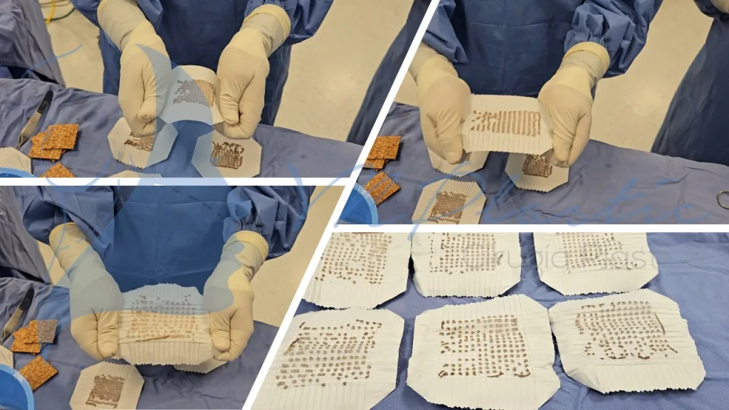 Microinjertos Meek: Innovación en el Tratamiento de Grandes Quemaduras y Pérdida de Tejido 7 expansion_microinjertos_meek