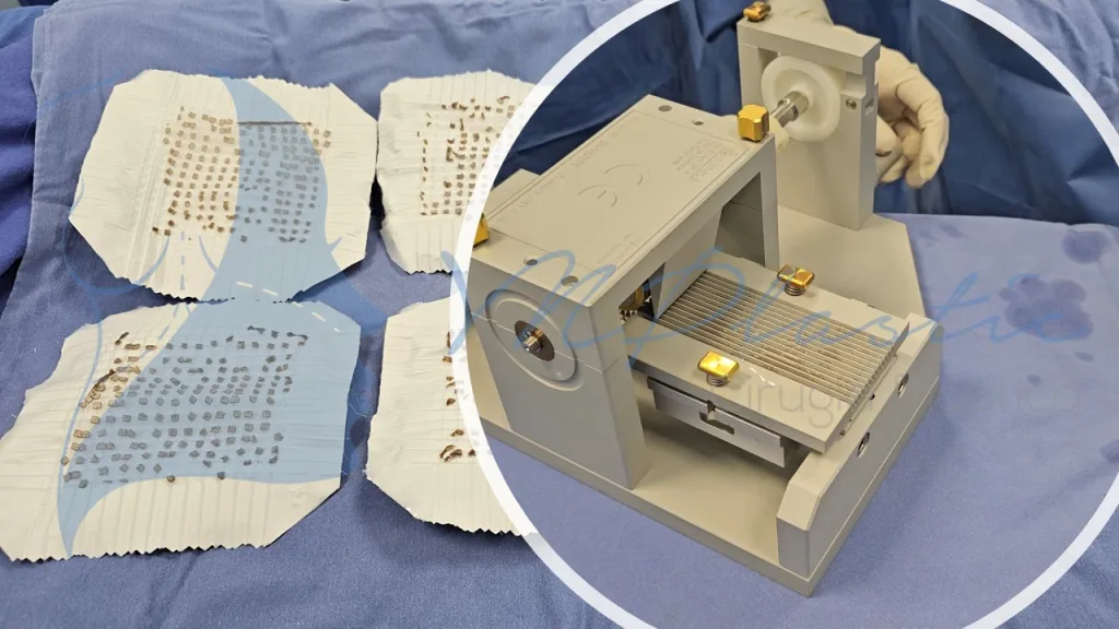 Microinjertos Meek: Innovación en el Tratamiento de Grandes Quemaduras y Pérdida de Tejido 1 Microinjertos Meek